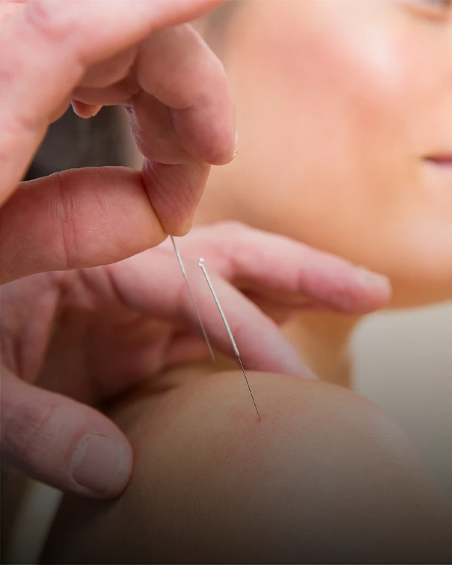 Close-up of a hand inserting an acupuncture needle into the shoulder area of a person during an acupuncture treatment